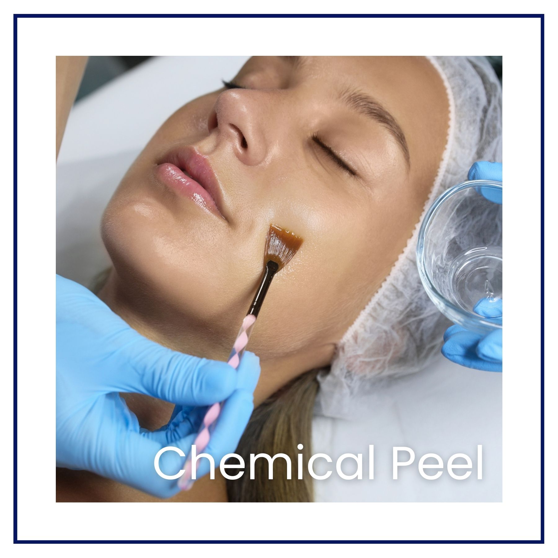 chemical peel application
