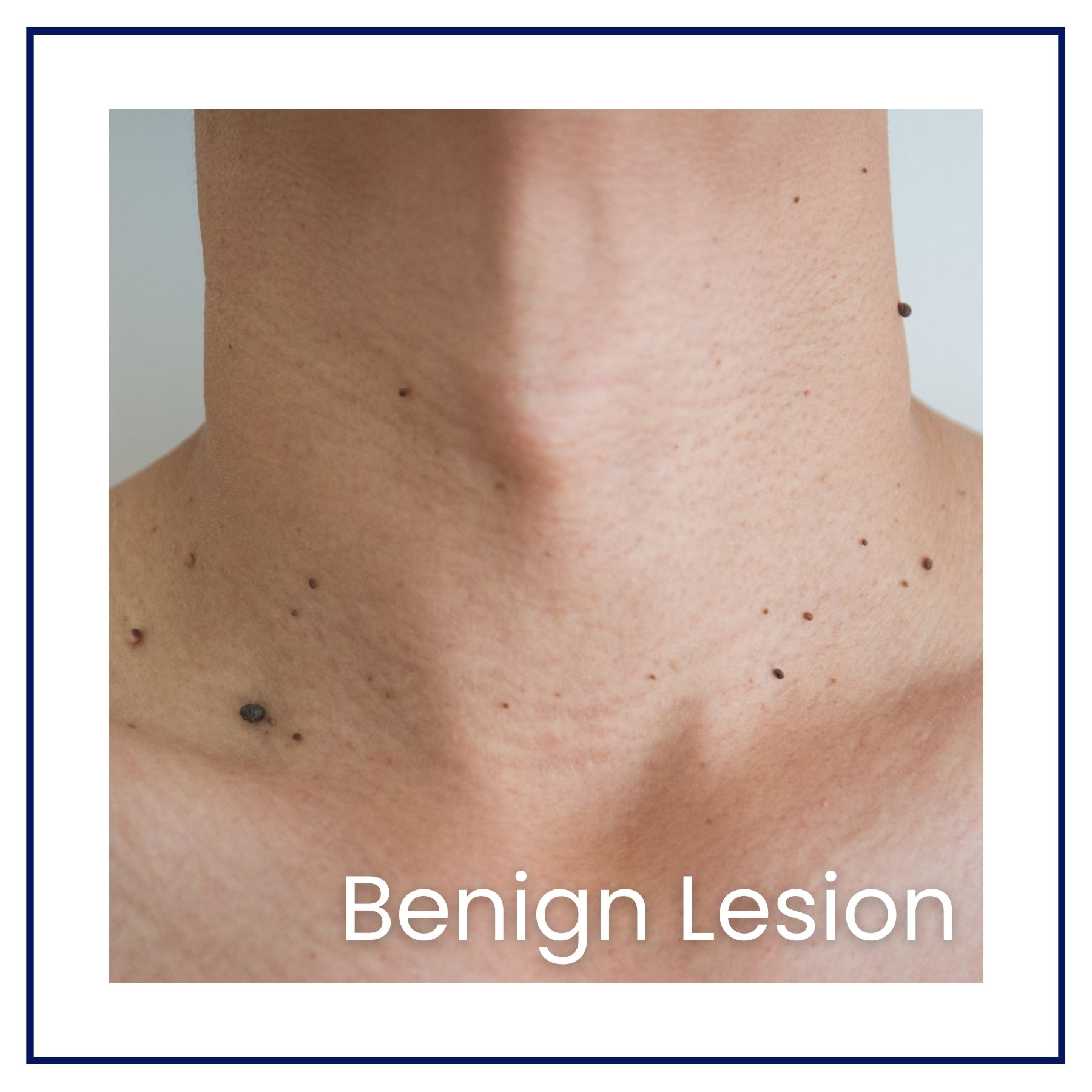 skin tags